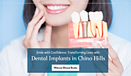 Smile with Confidence: Transforming Lives with Dental Implants in Chino Hills – Hillcrest Dental Studio