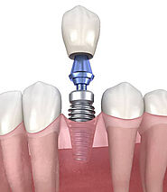 Dental Implants in Albuquerque, NM | Uptown Dental Associates