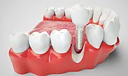Dental Implants in Albuquerque: The Ultimate Guide to Permanent Tooth Replacement