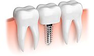 4 Advantages and Disadvantages of Dental Implants You Must Know