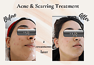 Aesthetic Treatments Blog | Skin NV Clinic London