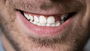 The Importance of Replacing Missing Teeth
