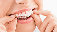 Uncovering the Benefits of Invisalign Treatment