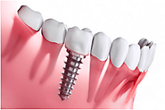 Discover the Benefits of Dental Implants: Smile Confidently Again!