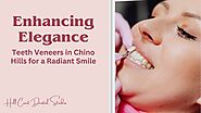 Enhancing Elegance: Teeth Veneers in Chino Hills for a Radiant Smile – Hillcrest Dental Studio