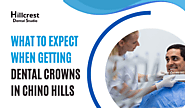 What to Expect When Getting Dental Crowns in Chino Hills: A Step-by-Step Guide - Hillcrest Dental Studio