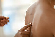 What Are the Different Types of Acupuncture Treatments Available in London? | Lifehack