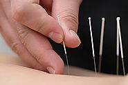 London's Acupuncture Odyssey: A Fusion of Ancient Wisdom and Modern Healing