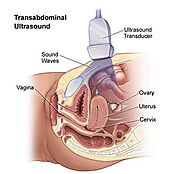 Pelvic Ultrasound or Sonogram - OB/GYN - Brooklyn Heights, NYC