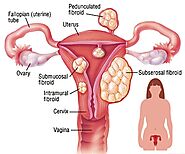 Uterine Fibroid Treatment - OB/GYN Physicians - Brooklyn Heights, NY