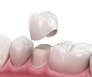 Get crown capping teeth fixed in Woodland Hills