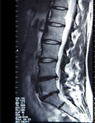 Spine Specialist New York City, Spine Surgery Westchester & Manhattan | Daveed D. Frazier, MD