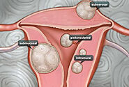 Hysteroscopic Myomectomy | OBGYN Center in NYC