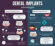 Dental Implants