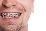 Adult Clear Invisible Braces | Best Dentist for Braces in Brooklyn