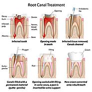 Why are dental crowns recommended after a root canal?