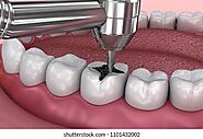 How do I prevent root canal treatment?
