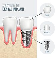 Implant Dentist in Woodland Hills | Dentist of Woodland Hills