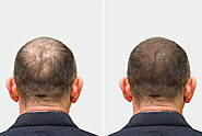 Hair Transplant in India - Best Hair Transplant cost in India