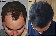 Best Hair Transplant in Gurgaon - Hair Transplant Doctor in Gurgaon