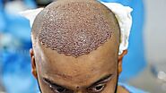 Best Hair Transplant in Mumbai, Hair Transplant Surgeon in Mumbai