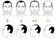 Hair Transplants and Treatment - Medihair India