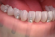 Full Mouth Dental Implants NYC