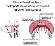 All-on-4 Dental Implants in New York City