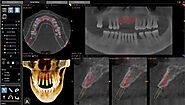 Breaking Down the Dental Implant Process Timeline