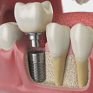 Dental Implants Problems | NYC Dental Implants | Manhattan NY