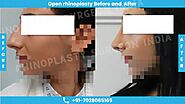What is Open Rhinoplasty Surgery?