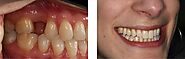 Dental Implants NYC | Top Periodontist in Midtown Manhattan