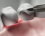 Laser Gum Surgery In Midtown Manhattan NYC