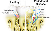 Periodontal Gum Disease Gingivitis Causes And Treatment