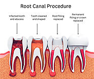 Root Canal Therapy in Brooklyn