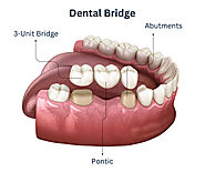 Dental Bridges in Brooklyn, NY