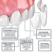 Dental Veneers Brooklyn, NY | Cosmetic Porcelain Veneers Cost