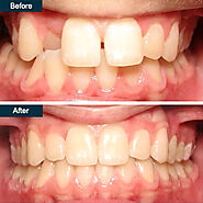 Invisalign® Before and After