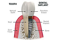 Dental Implant Structure