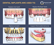 Dental Implants