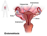 Endometriosis