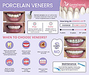 Veneers