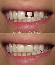 Achieve Stunning Zirconia Crown Front Teeth in Woodland Hills