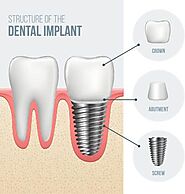 Affordable implant denture by Dentist of Woodland Hills