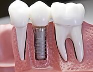 Dental Implant in Los Angles | Dentist of Woodland Hills