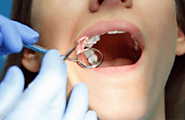 A Guide to Securing an Affordable Root Canal with Tact!