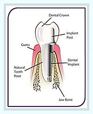 Dental Implants Treatment in Melbourne by Healthy Smiles