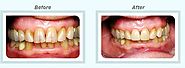 Porcelain Crowns and Veneers Treatment by Healthy Smiles