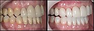 False Teeth Dentures & Full Mouth Rehabilitation by Healthy Smiles