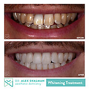 TEETH-WHITENING